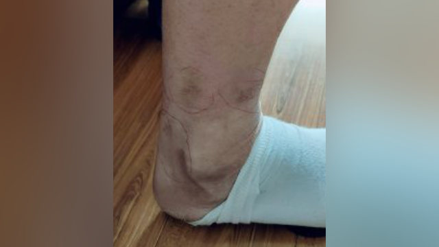 Scars left on Mr. Zhao’s leg from torture with electric batons.