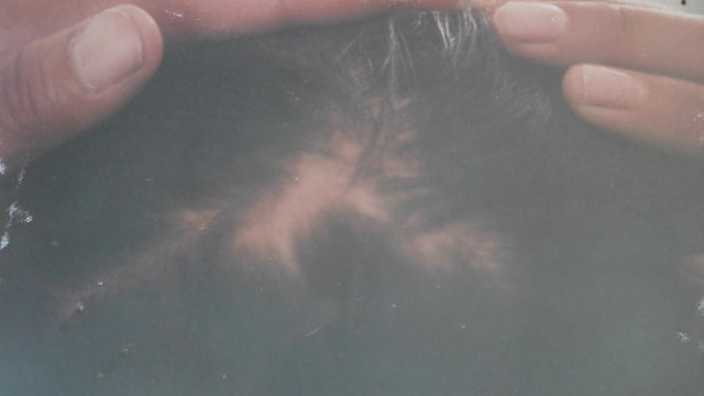 The bald patch on Li Yi’s head, caused by torture during interrogation.